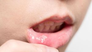 Fiese Entzündungen im Mund: Was hilft bei Aphthen?