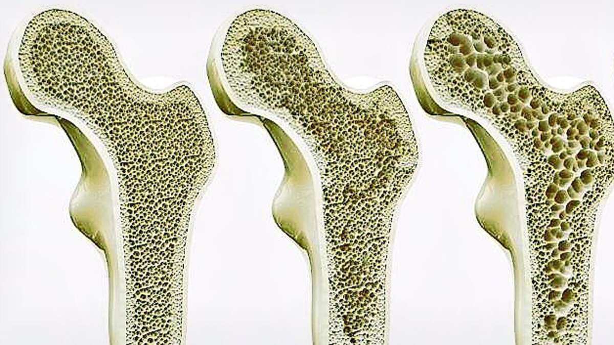 Tipps zum Weltosteoporosetag: Knochenschwund trifft auch Jüngere