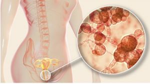 Candida auris: Gefahr durch resistenten Hefepilz