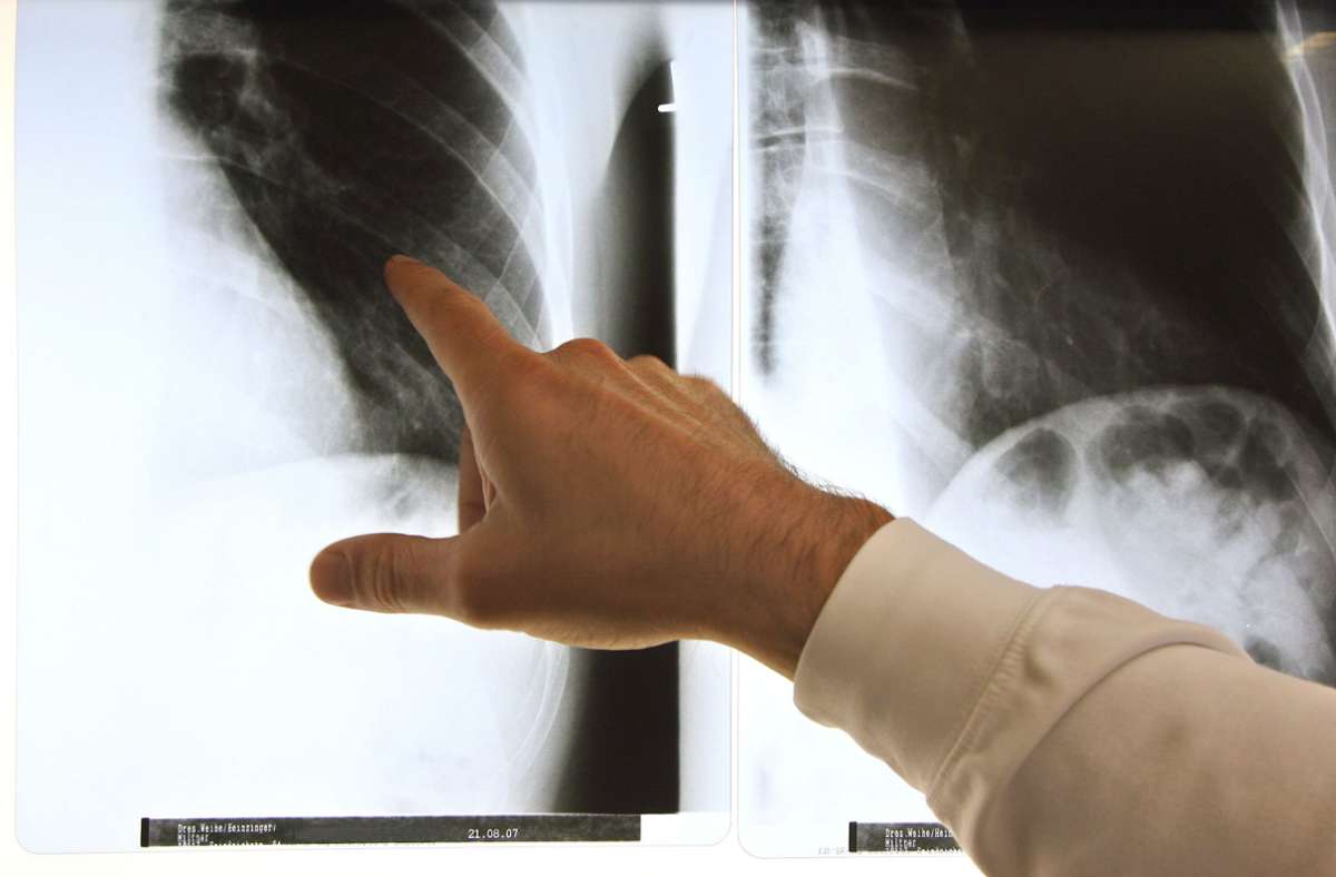Forscher aus Baden-Württemberg: Röntgenaufnahmen sollen Corona erkennen