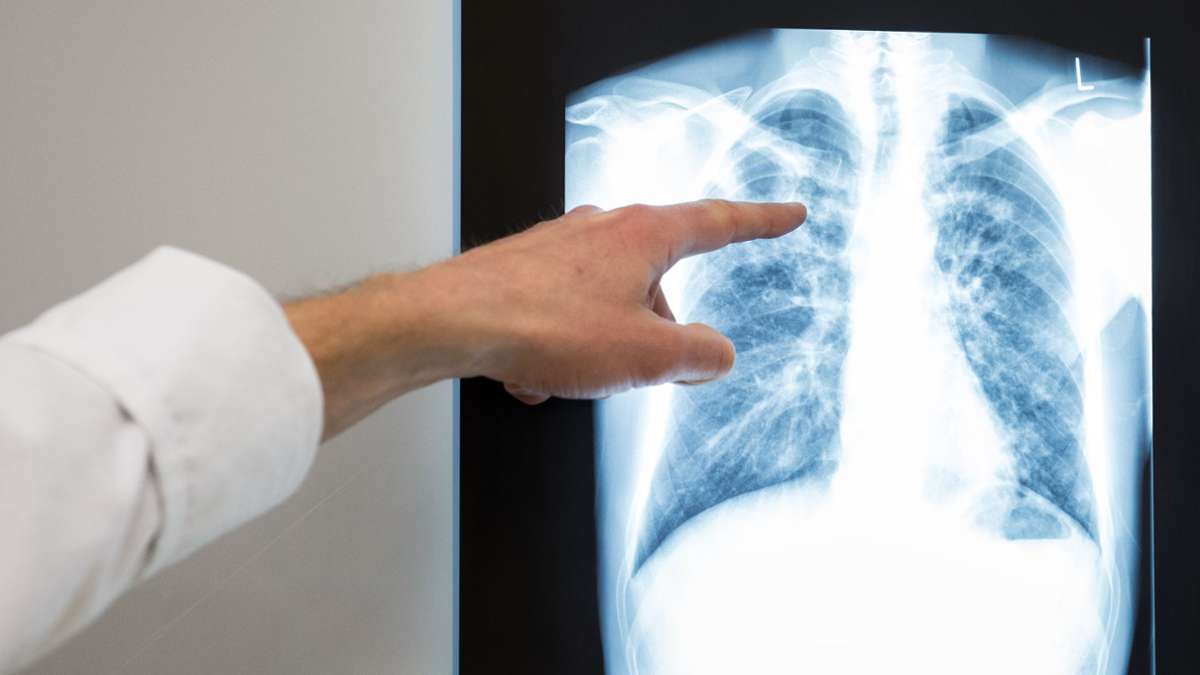 Baden-Württemberg: Zahl der Tuberkulose-Fälle nimmt deutlich zu