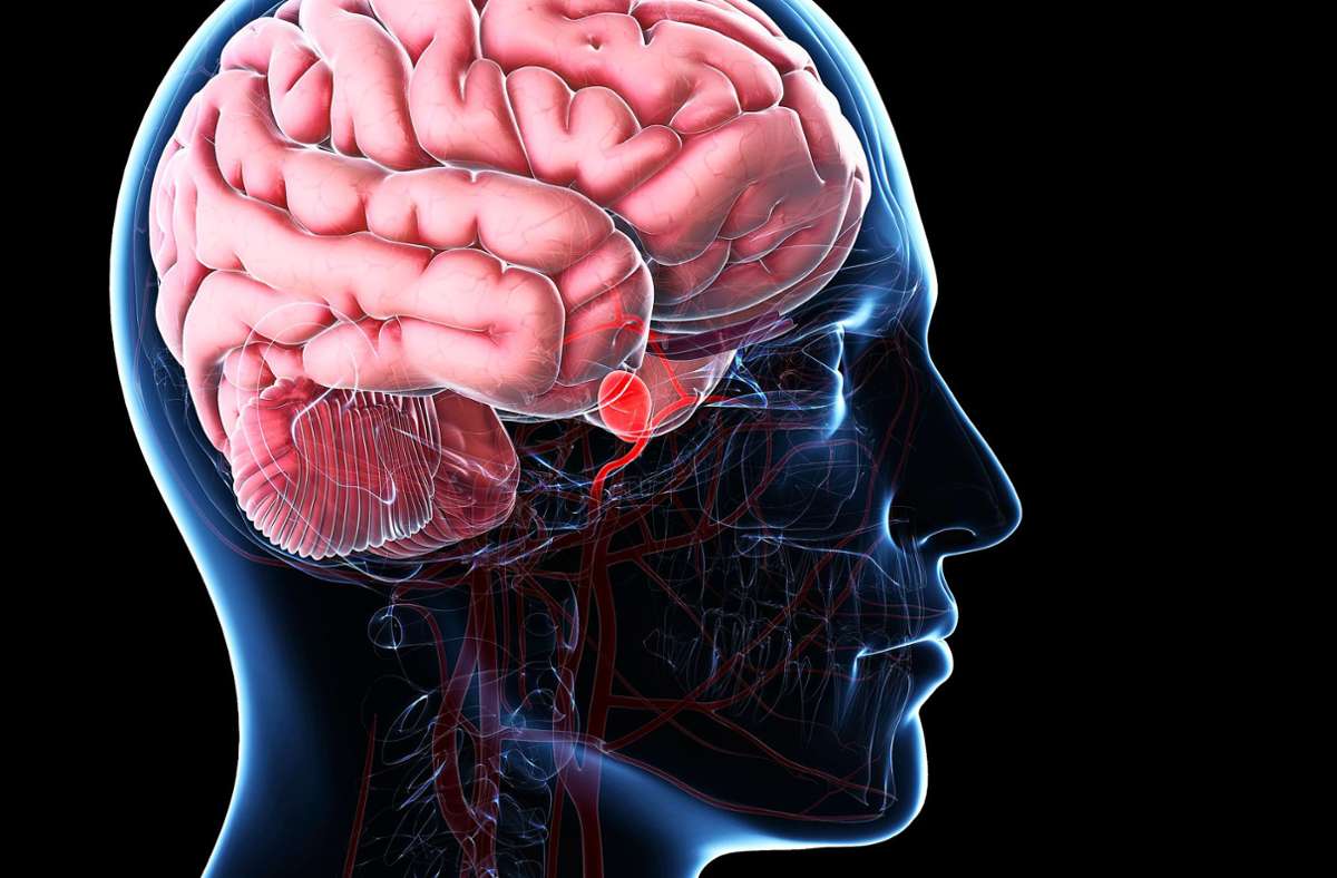 Aneurysma im Gehirn: Tickende Zeitbomben im Kopf?