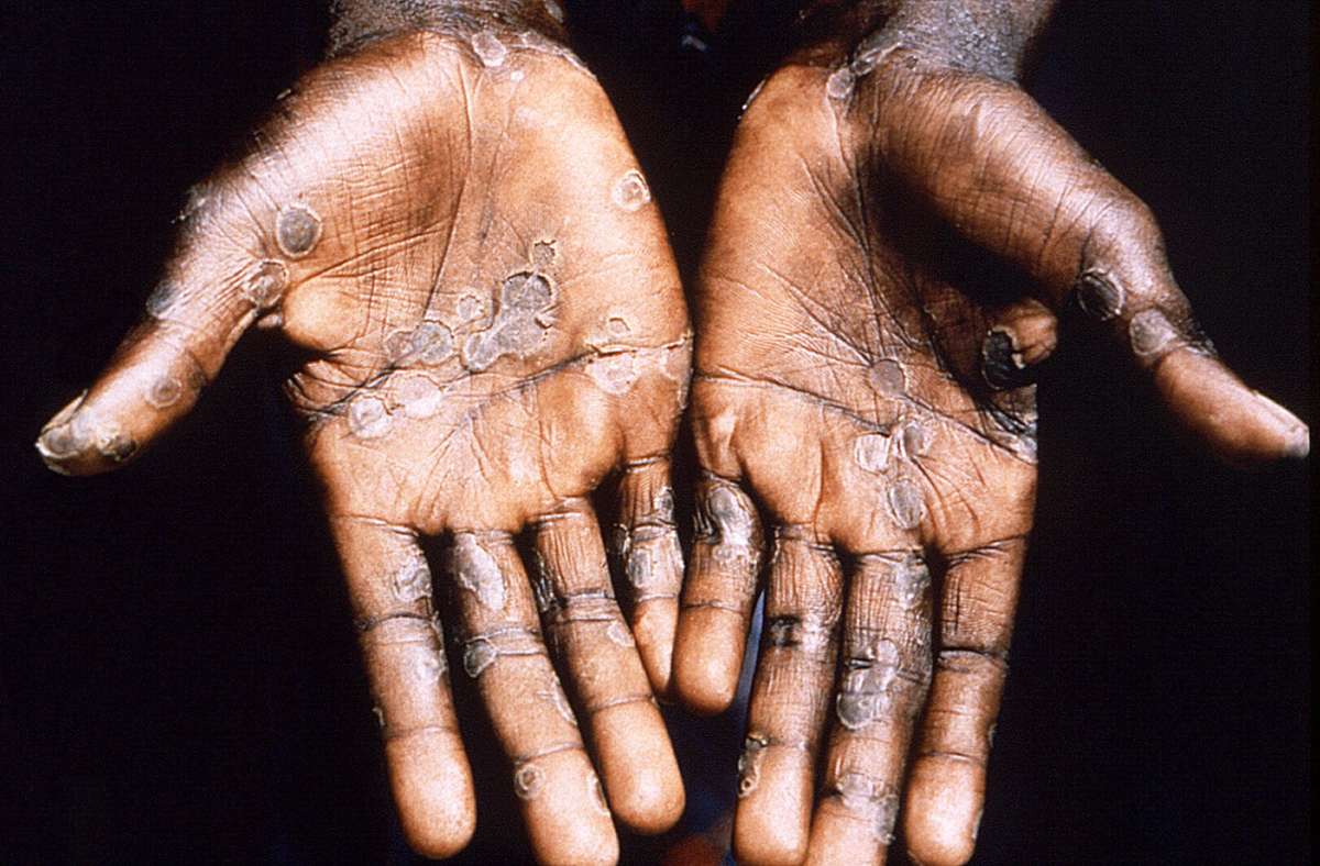 Meist kommt es bei einer Infektion zu einem vom Gesicht auf den Körper übergreifenden, pockentypischen Ausschlag. Foto: dpa/Brian W.J. Mahy